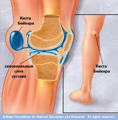 Киста бейкера коленного сустава лечение лазером