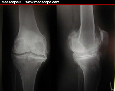 Остеофиты коленного сустава, лечение в Москве