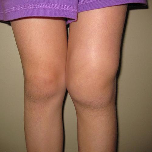 Клиника артрит коленного сустава thumbnail