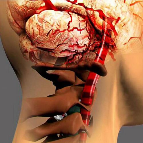 Что такое синдром вертебральных артерий