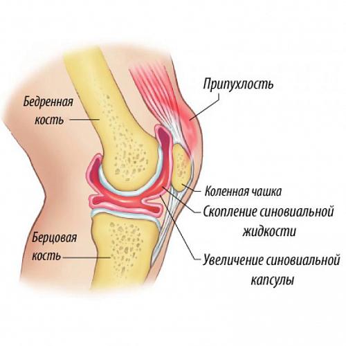 Стандарты лечения синовита коленного сустава thumbnail